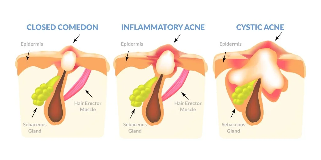 4 Facial Treatments for Instant Beauty Boost 2 image of cortisone shots: closed comedon, inflammatory acne, cystic acne
