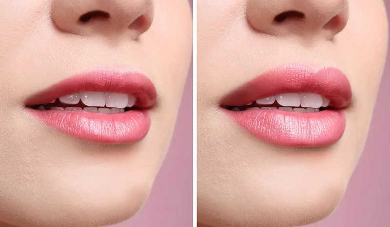 My First Time Getting Lip Fillers: Here’s What to Expect… 4 image of before and after lip filler in Plantation near me
