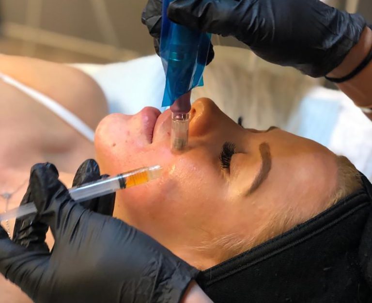 image of Los mejores tratamientos para las cicatrices del acné