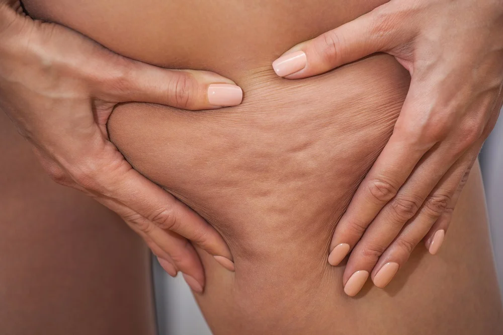 6 Common Skin Issues and How to Deal with Them 3 image of cellulite treatment in Plantation med Spa Florida