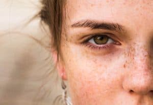 image of How to Fight Dark Spots on Skin