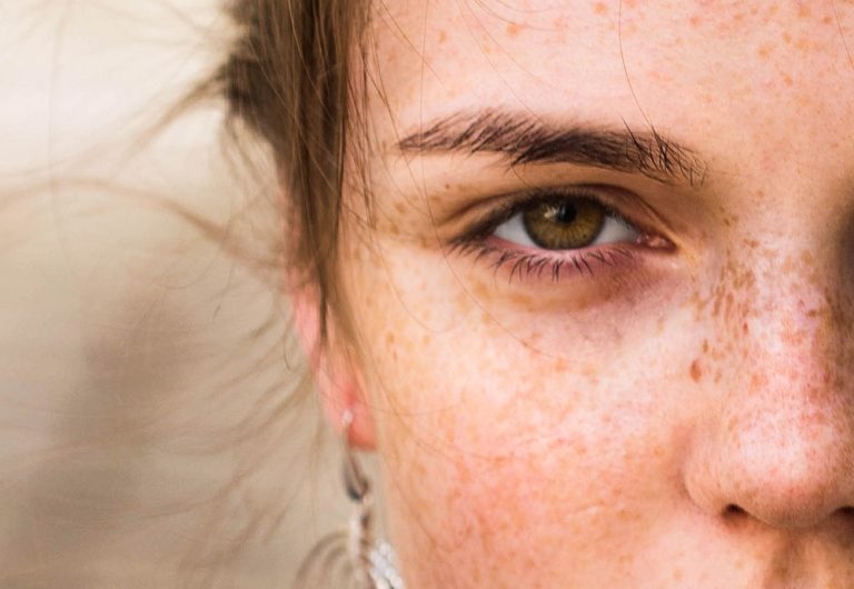 image of Cómo combatir las manchas oscuras en la piel
