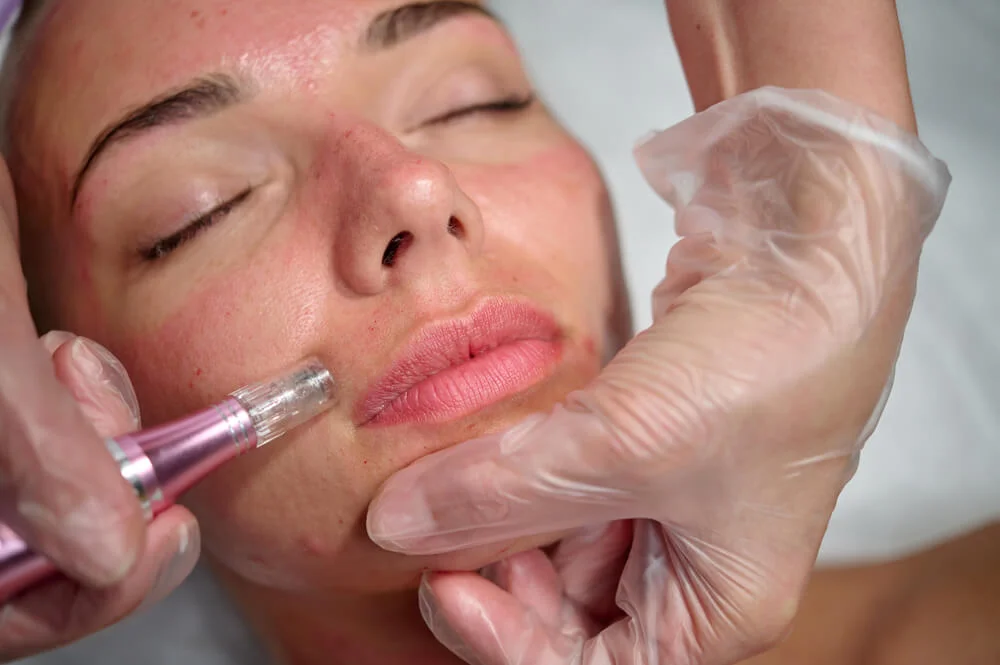 The Top Med Spa Treatments For Aging Skin 5 image of microneedling at Plantation Med Spa, Florida
