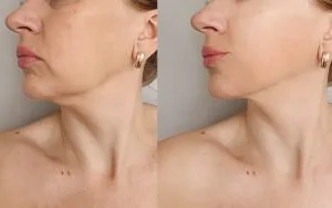 image of Injectables and Fillers: Enhancing Facial Features at the Med Spa