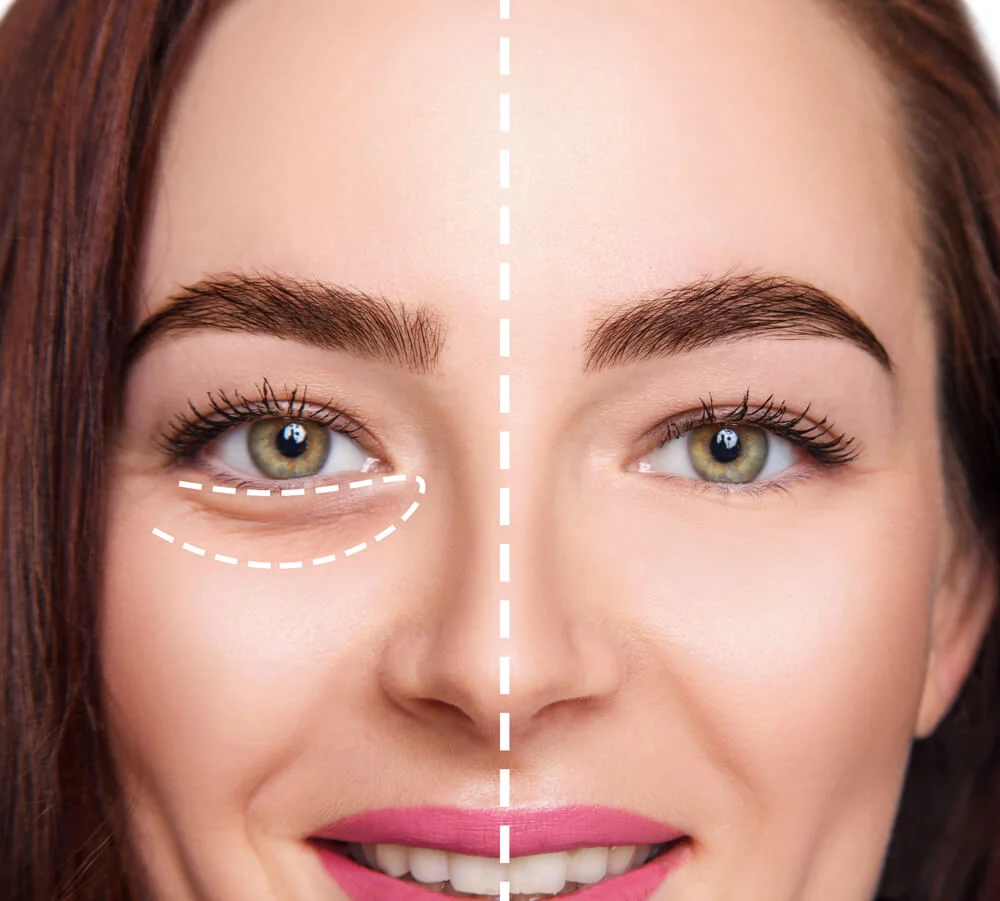 Injectables and Fillers: Enhancing Facial Features at the Med Spa 6 image of Lift Saggy and Baggy Skin Around the Eyes