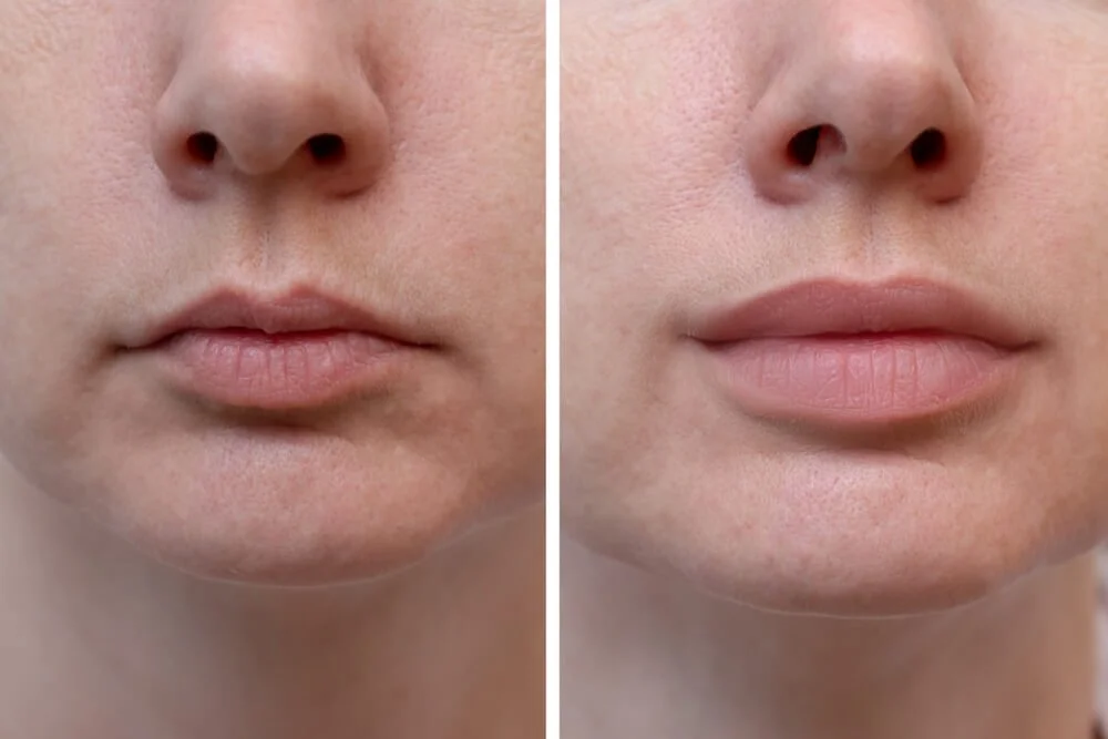 Injectables and Fillers: Enhancing Facial Features at the Med Spa 1 image of plumb up your lips, before and after