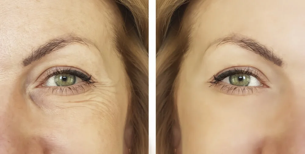 Injectables and Fillers: Enhancing Facial Features at the Med Spa 2 image of Smooth Away Wrinkles, before and after