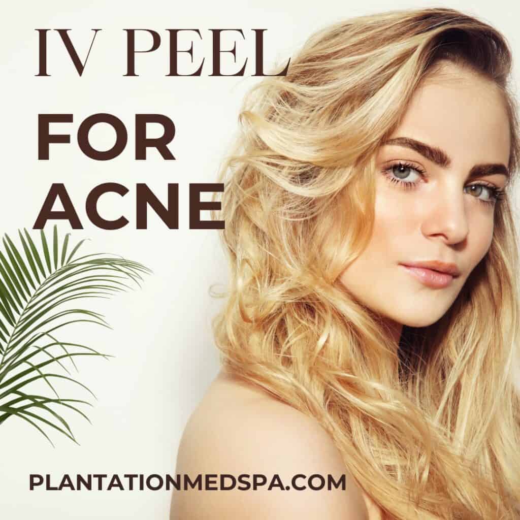 Vi Peel for Acne Treatment at Plantation Florida 6 image of ¿Es el lifting facial Silhouette Instalift adecuado para usted?