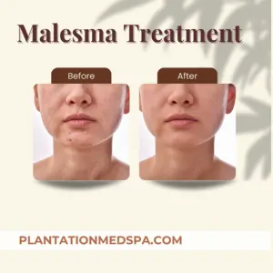 image of Melasma reduction treatment at Plantation Med Spa