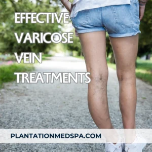 image of The Best Effective Varicose Vein Treatments