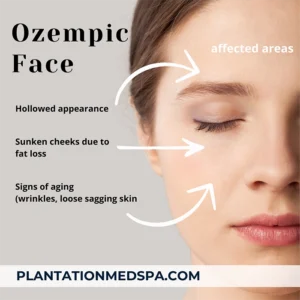 What Is Ozempic Face? Understanding the Side Effects of Rapid Weight Loss