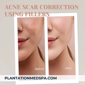 image of acne scar correction using dermal fillers in Plantation, Florida