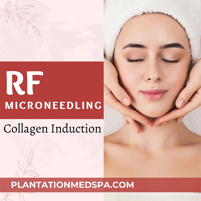 RF Microneedling: unleashing Collagen minimizing downtime for radiant skin in Plantation, Florida