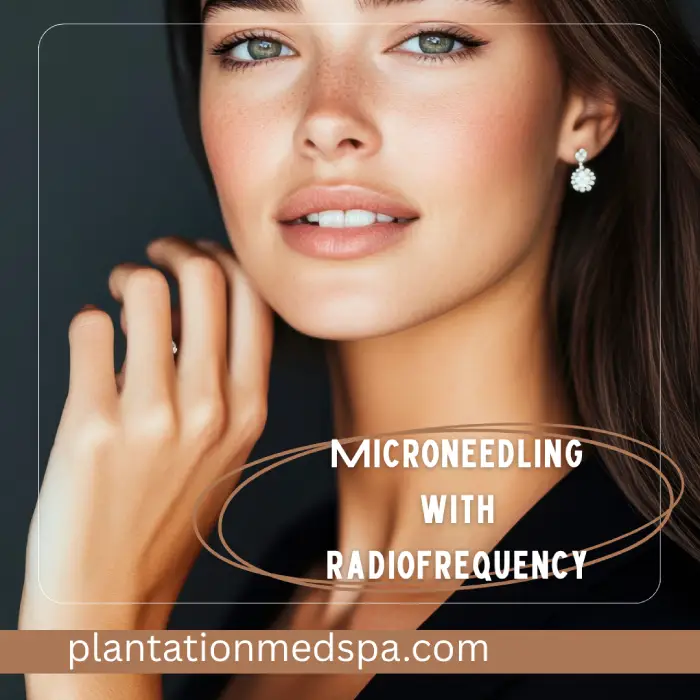 Microneedling con Radiofrecuencia: Transformación de cicatrices de acné y líneas de expresión