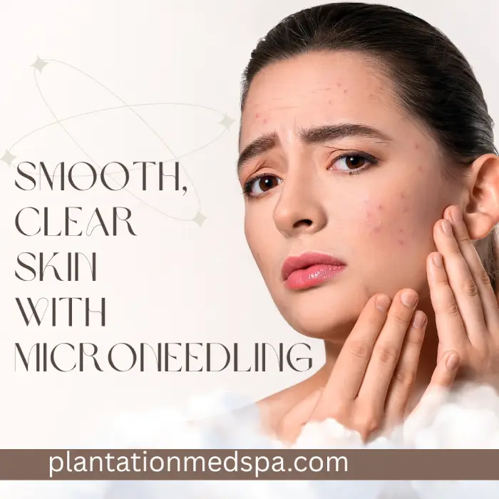 Microneedling for Acne Scars: The Ultimate Guide to Smooth Clear Skin
