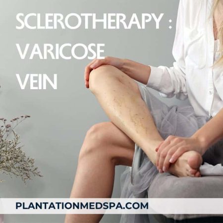 imagen del tratamiento de varices para unas piernas perfectas con escleroterapia