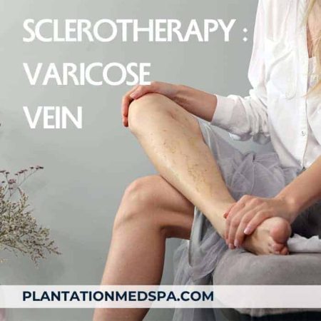 imagen del tratamiento de varices para unas piernas perfectas con escleroterapia